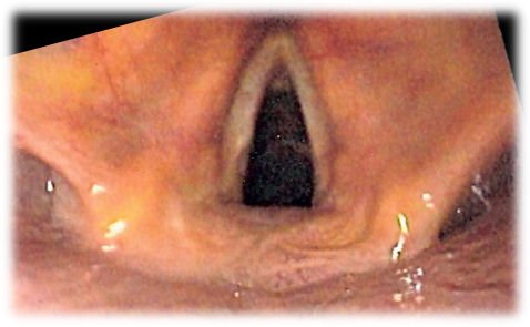 Video Laryngoscopy at Capstone Clinic