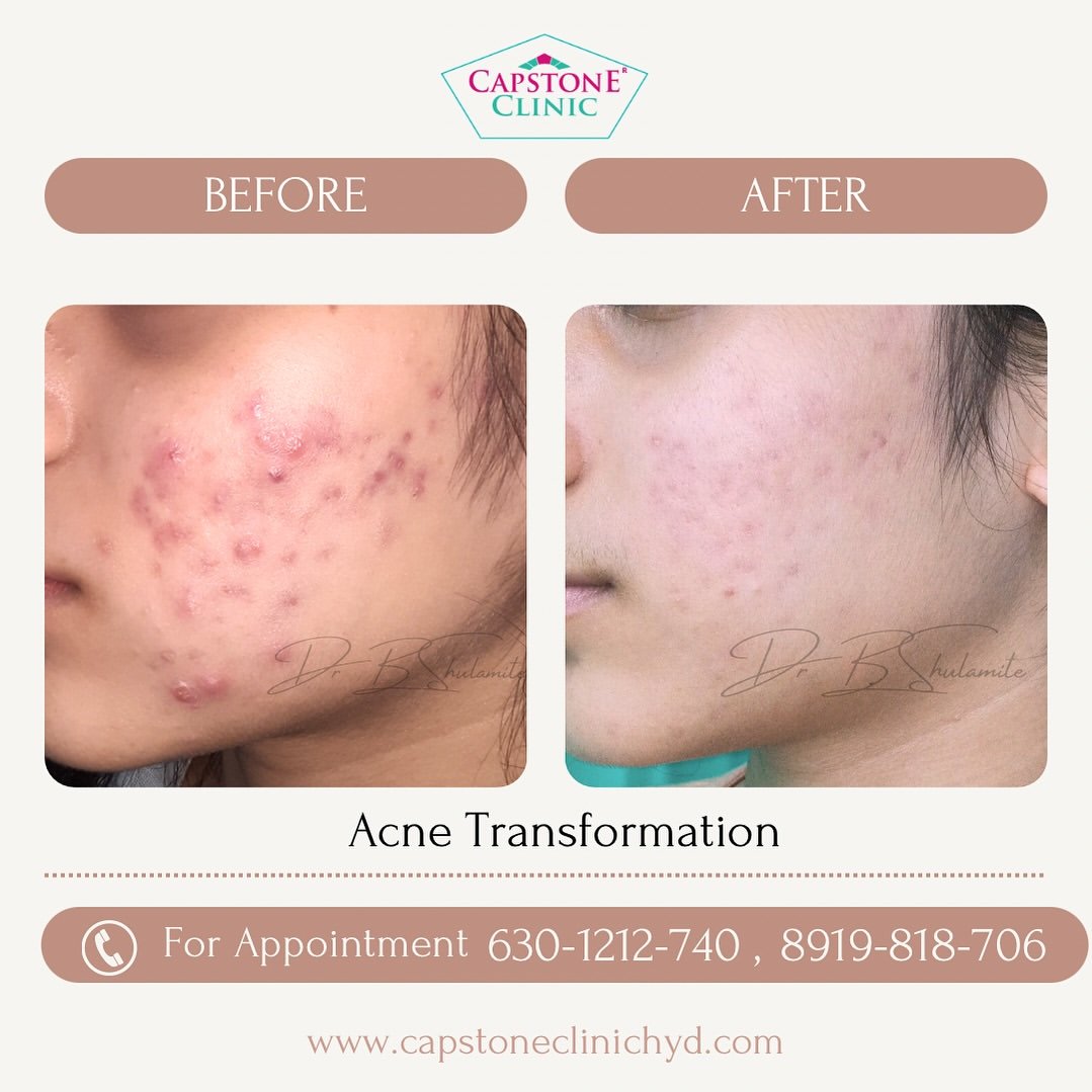 Severe Inflammatory Acne to Smooth Clear Skin Transformation