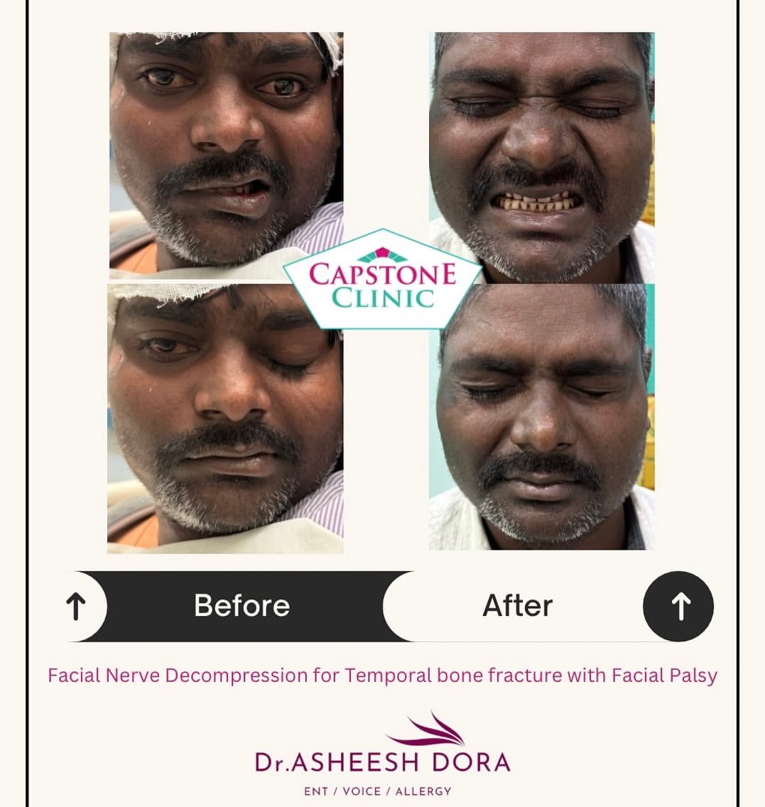 Thyroplasty & Glottoplasty at Capstone Clinic