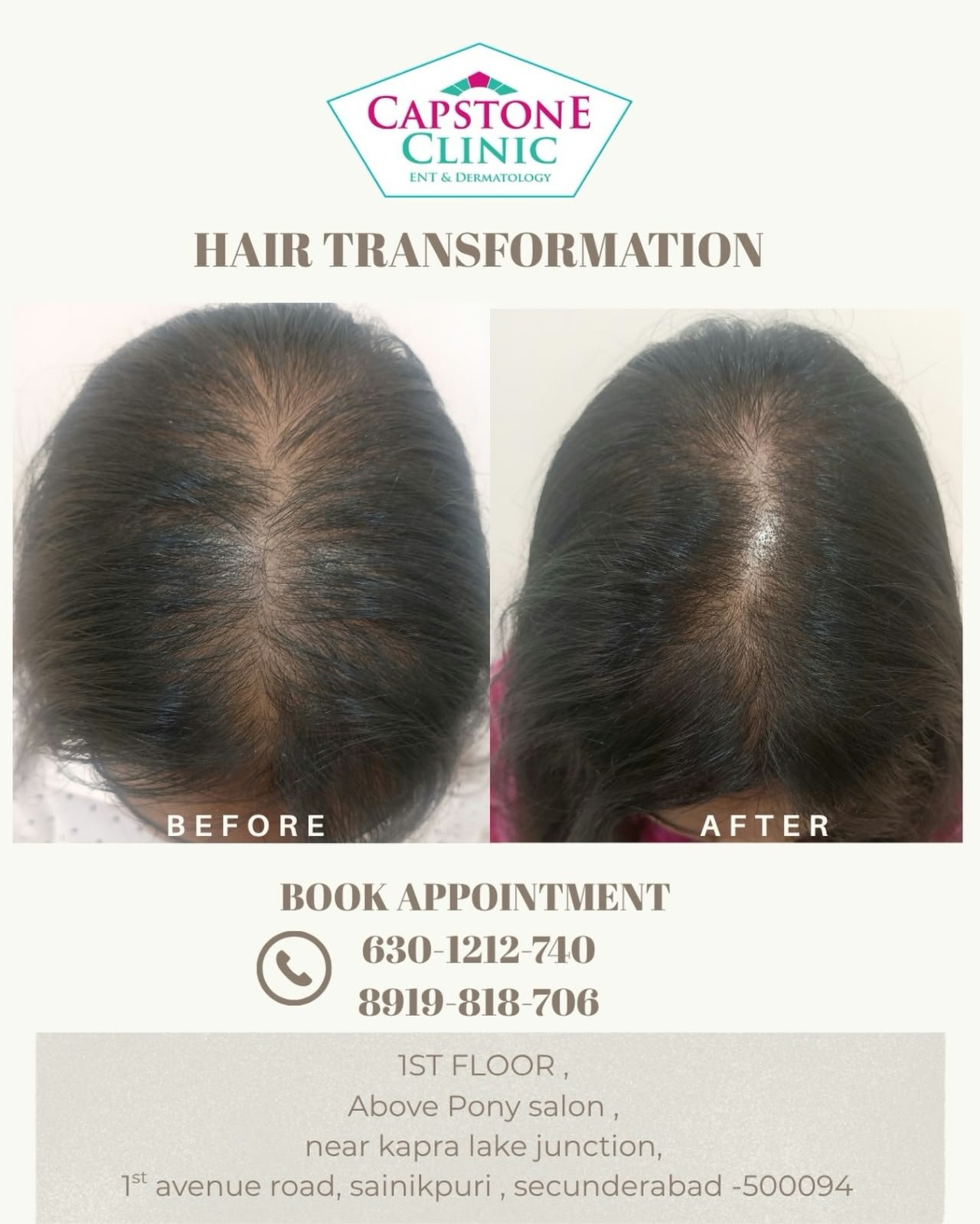 Female Pattern Hairline and Parting Density Restoration